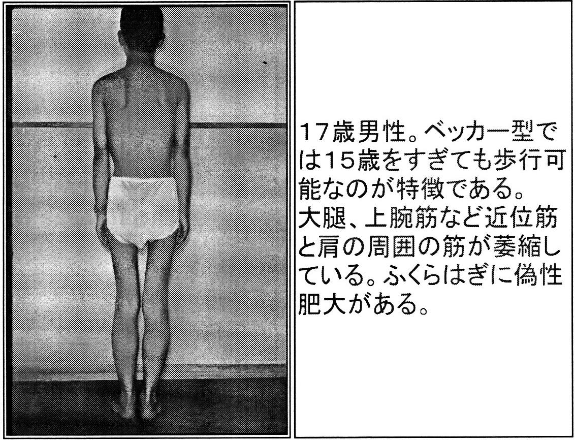 医師はベッカー型筋ジストロフィーをどのように診断しますか?